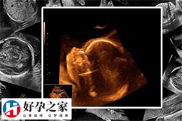 二维彩超和四维彩超的差异