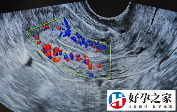 子宫内膜血流2级不能做试管移植?内膜血流利于胚胎着床的等级